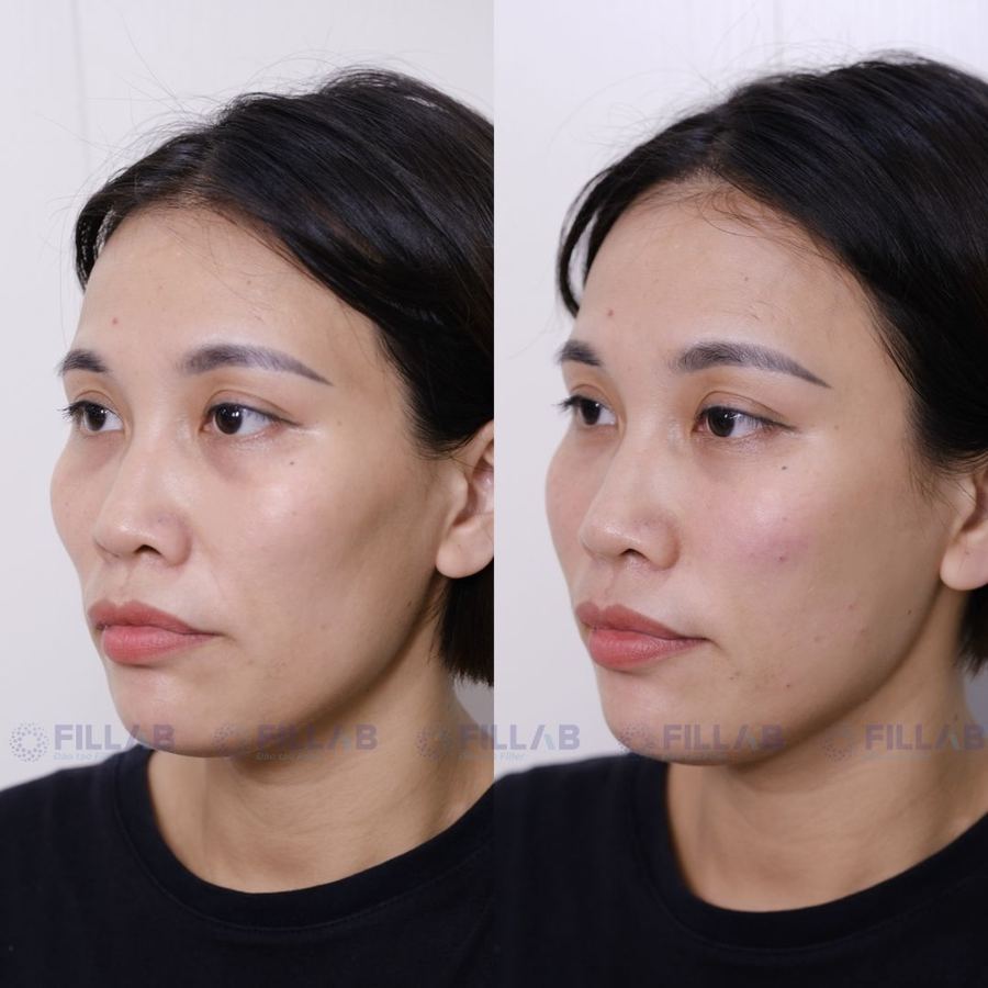 Ca before - after của học viên FILLAB
